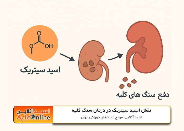 دفع سنگ کلیه با اسید سیتریک