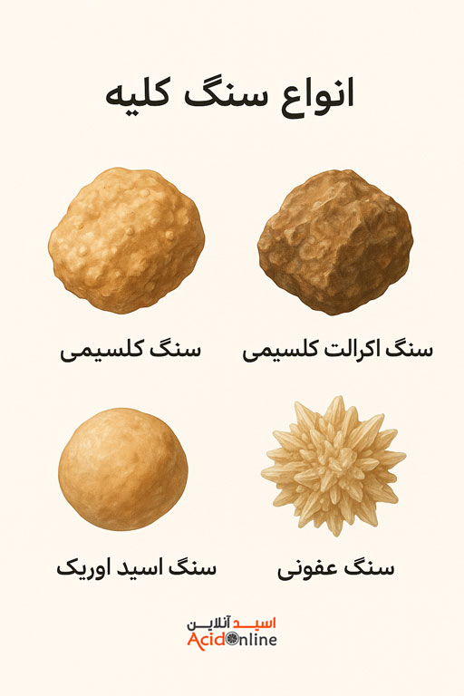 سنگ کلیه و اسید سیتریک